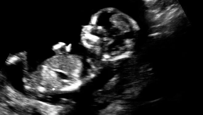 Anne karnındaki bebek kalp ameliyatı oldu