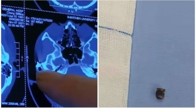 Çin'de başı ağrıyan adamın kafasında mermi bulundu