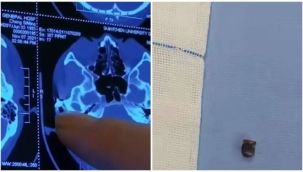 Çin'de başı ağrıyan adamın kafasında mermi bulundu