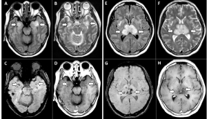Covid-19 beynin küçülmesine neden oluyor