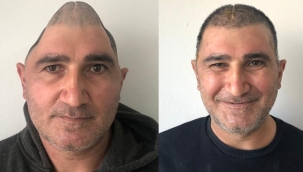 Gülhane'de eksik kafatası titanyumla tamamlandı