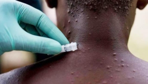 11 ülkede 80 maymun çiçeği vakası tespit edildi