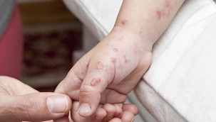 DSÖ, maymun çiçeği vakalarının artmasını bekliyor