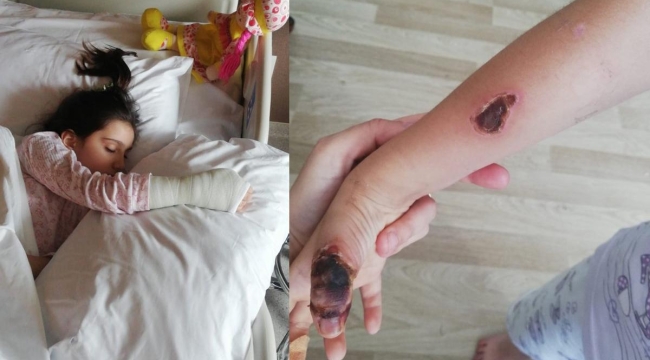 İstanbul'da, küçük kızın eli MR çekilirken yandı