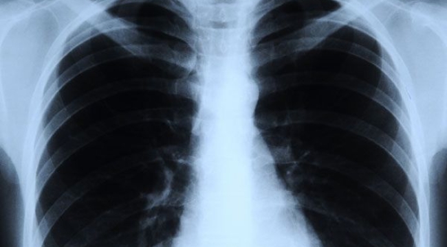 Yapay zeka röntgenden ırkları tespit ediyor 