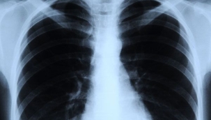 Yapay zeka röntgenden ırkları tespit ediyor 