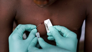 Afrika'da 44 maymun çiçeği vakası tespit edildi