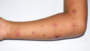 Dünyada maymun çiçeği vaka sayısı 780 oldu