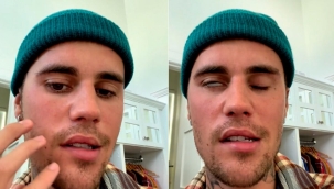 Justin Bieber yüz felci geçirdi