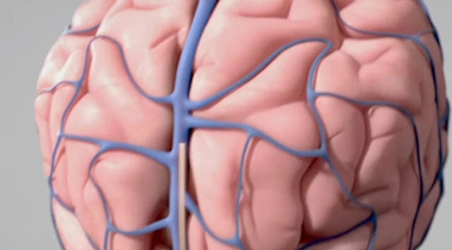 ABD'li Synchron, insan beynine çip yerleştirdi