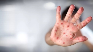 Yeni Zelanda'da ilk maymun çiçeği vakası