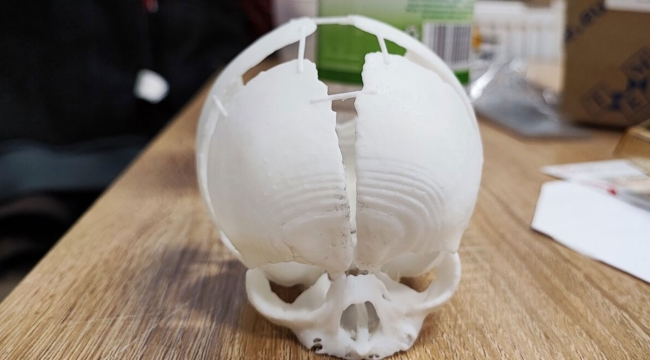 3D yazıcı ile basılan kafatası, hayat kurtardı
