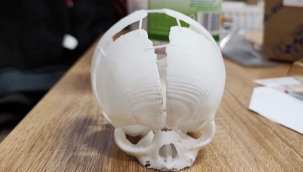 3D yazıcı ile basılan kafatası, hayat kurtardı