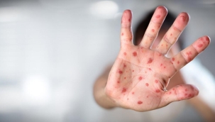 ABD maymun çiçeği nedeniyle acil durum ilan etti