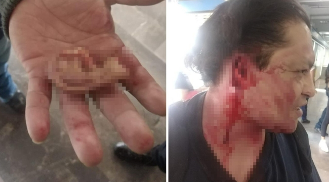 Kavga ettiği kişinin kulağını ısırarak koparttı