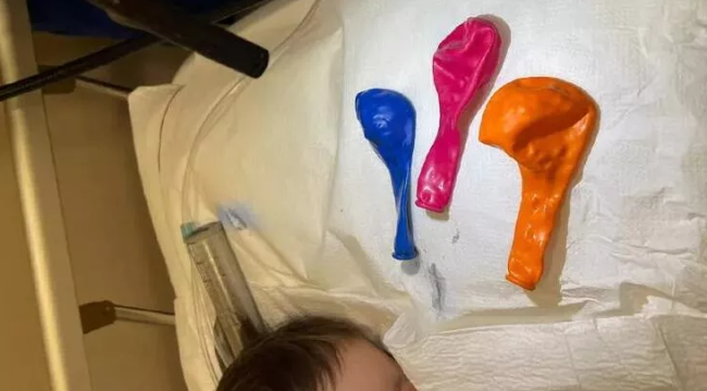 Gaziantep'te bir bebeğin midesinden 3 balon çıktı