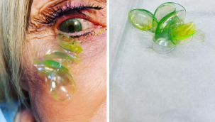 Kaliforniya'da bir kişinin gözünden 23 lens çıktı