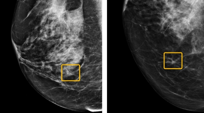 Google'dan meme kanserine karşı iCAD ile ortaklık