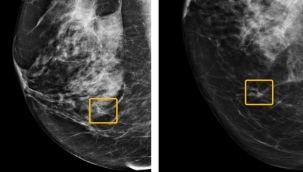 Google'dan meme kanserine karşı iCAD ile ortaklık