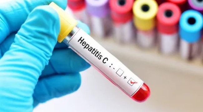 İngiltere, Hepatit C'yi 2 yılda bitirmeyi istiyor