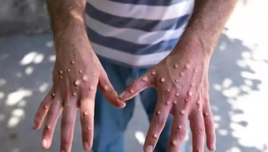 Pakistan'da ilk maymun çiçeği vakası görüldü