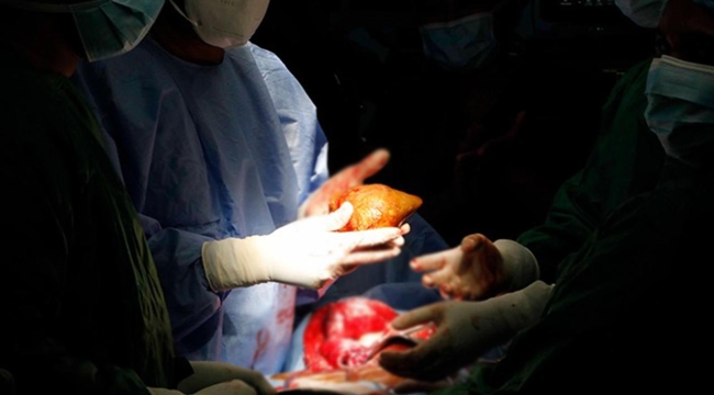 Sri Lanka'da bir hastada 801 gr böbrek taşı çıktı