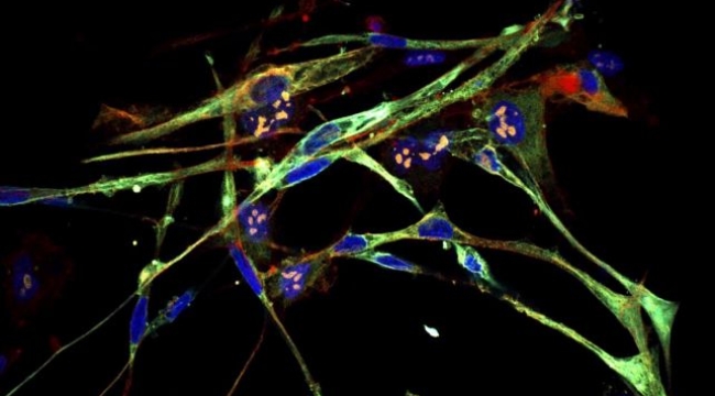 ABD'de agresif kanser hücreleri kasa dönüştürüldü