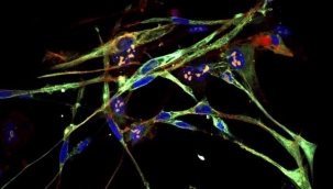 ABD'de agresif kanser hücreleri kasa dönüştürüldü