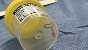 Canberra'da kadının beyninden canlı solucan çıktı