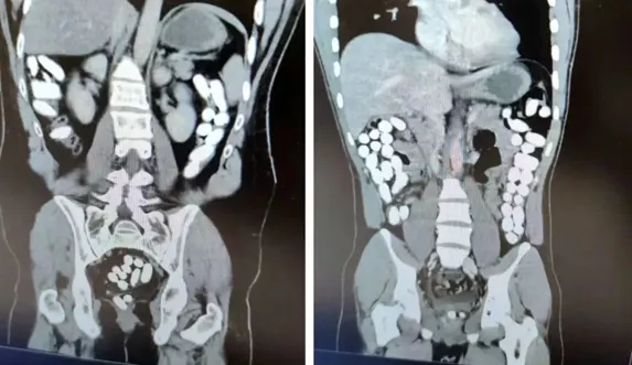 Erzincan'da iki İranlının midesinden "afyon" çıktı