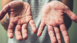 2023'te Avrupa'da kızamık vakaları 30 kat arttı