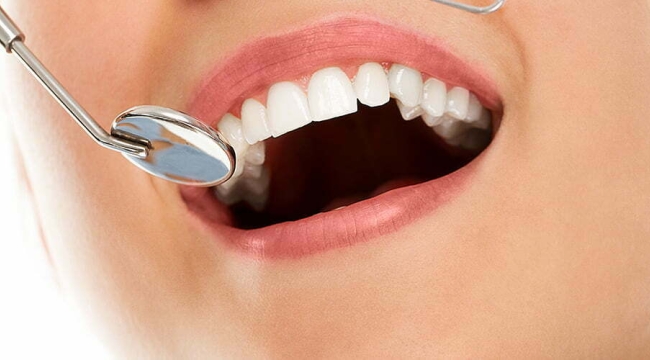 AB, cıvalı amalgam dolguyu yasaklıyor