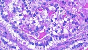 Çinli YZ %90 doğrulukla kanser tespit edebiliyor