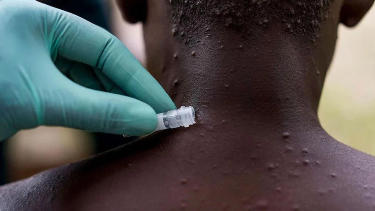 Afrika'da ''maymun çiçeği virüsü'' vakaları artıyor