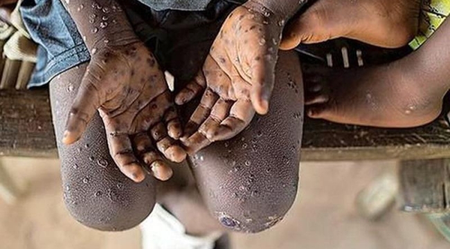 Pakistan'da 3 kişide maymun çiçeği tespit edildi