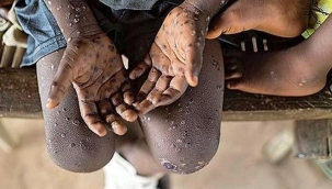 Pakistan'da 3 kişide maymun çiçeği tespit edildi