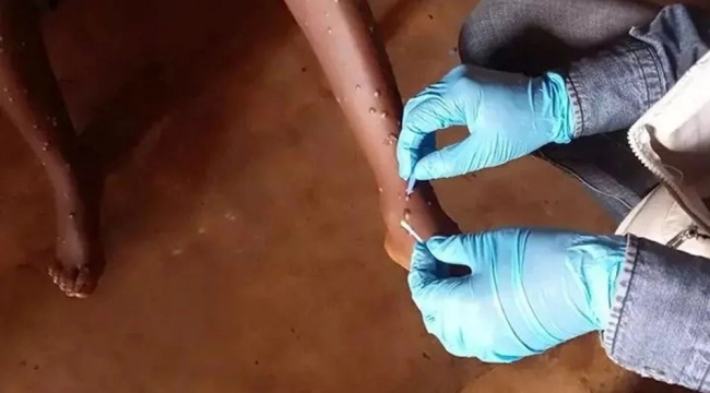 Zimbabve ve Zambiya'da M çiçeği tespit edildi