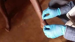 Zimbabve ve Zambiya'da M çiçeği tespit edildi