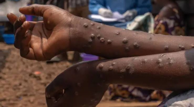 2025'te M. çiçeğinden ilk ölüm Etiyopya'da