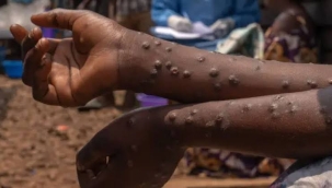 2025'te M. çiçeğinden ilk ölüm Etiyopya'da