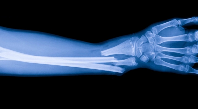 Çin'den 3 dakikada kemik kırığı tedavisi: Bone-02