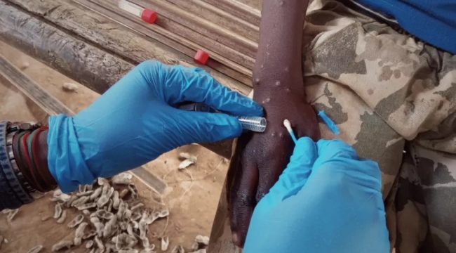 Gana'da M çiçeği virüsü: Son 5 ayda 583 vaka