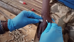 Gana'da M çiçeği virüsü: Son 5 ayda 583 vaka