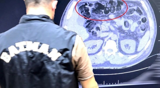 Otobüs yolcusunun midesinde uyuşturucu çıktı