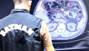 Otobüs yolcusunun midesinde uyuşturucu çıktı